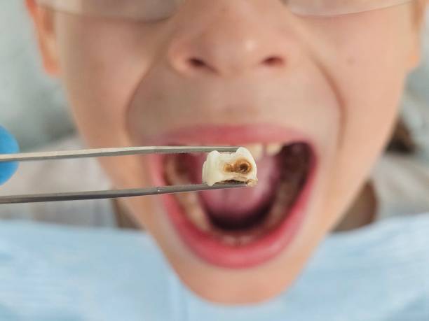 Best Emergency Dental Care for Broken or Chipped Teeth in Mapleton, IA